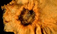 File:Adenocarcinoma of the stomach.jpg